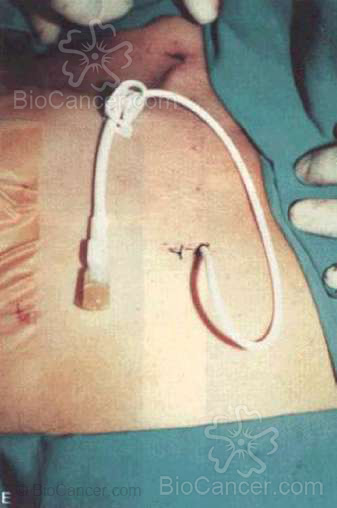 Catéter de Hickman implantado a través de la vena yugular interna derecha