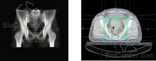 Irradiación pélvica de base (izqda.) y dosimetría de técnica de irradiación con cuatro campos, anterior, posterior, lateral derecho y lateral izquierdo (dcha.) añadiéndose radioterapia postoperatoria en caso de factores de riesgo