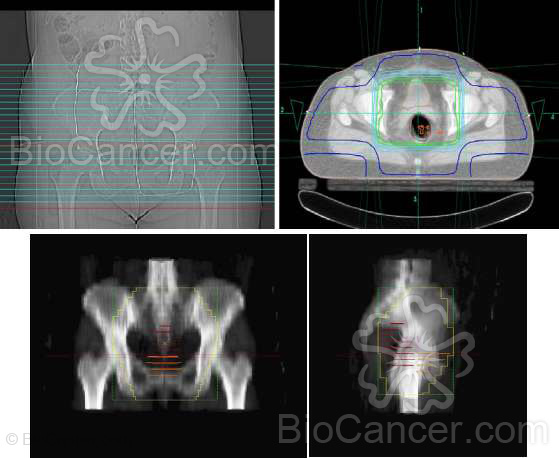 Principios generales del cáncer › Cáncer de cérvix › 9. Tratamiento. Dosimetría