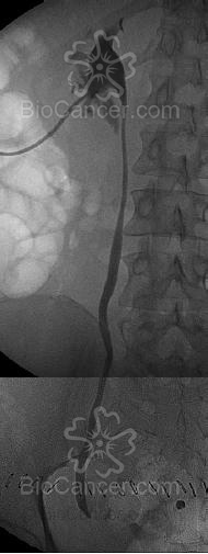 Nefrostomía percutánea  mostrando la pielografía descendente: oslusion del ureterdistal